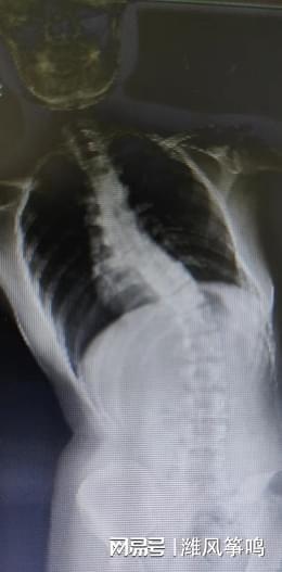 <em>阳光融和医院</em>脊柱二科成功开展高难度脊柱侧弯矫形+截骨后植骨术|