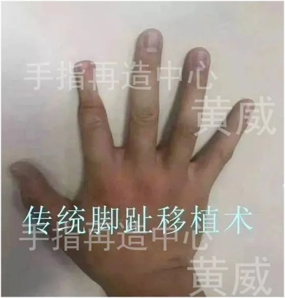 全球排名第一的手指再造案例，看后让人惊叹！<em>黄威</em>|3d打印|显微|手术|外科_网易订阅