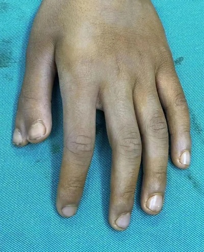 <em>雅安</em>仁康<em>医院</em>成功为拇指多指畸形男童巧施“减指整形”手术|显微|创伤|关节囊|人工膝关节_网易订阅