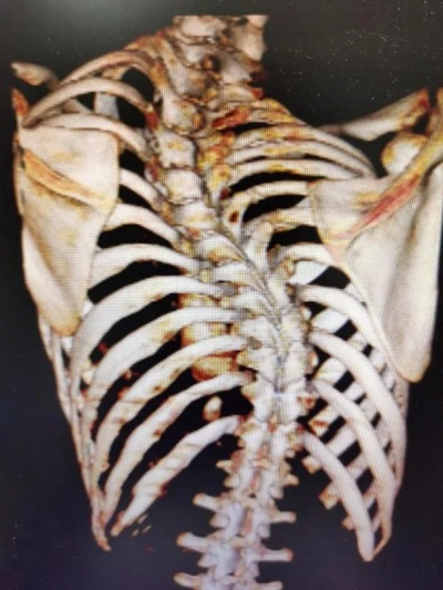 14岁少年重度漏斗胸和<em>脊柱</em>侧弯，<em>骨科</em>与心胸<em>外科</em>联手，一次手术修复两种畸形