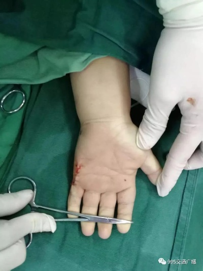 <em>浏阳</em>一宝宝出生时双手双脚均为六指，<em>医院</em>实施手术矫正成功！