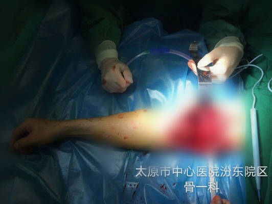 <em>太原市中心医院</em>应用背阔肌皮瓣成功完成一例屈肘的功能重建