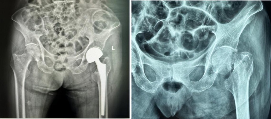 兰大二院<em>西固医院骨科</em>成功为86岁高龄患者实施人工股骨头置换术