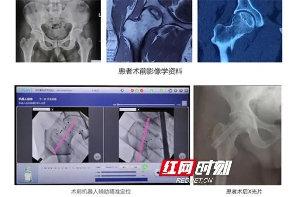 <em>湘雅骨科</em>“天玑”手术机器人辅助导航定位完成省内首例股骨头坏死保髋治疗