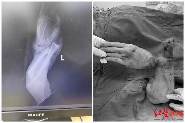 57岁洗衣工手腕被铰断，<em>骨科医生</em>9小时手术再植，一半多时间在<em>显微镜</em>下接血管