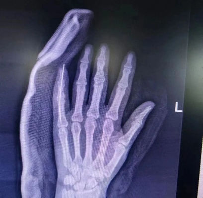 显微镜下的精雕细琢 肥城<em>医院</em>手足显微外科血管移植保障离断手指成功复活