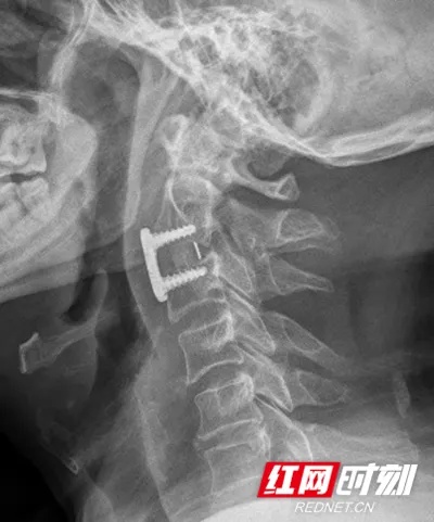 永州市中心医院：<em>脊柱外科</em>让上颈椎患者重新站起来