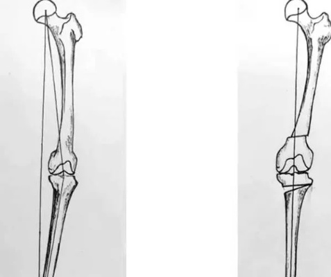 <em>骨科</em>手术技术股骨和胫骨双部位截骨治疗复杂膝关节冠状位内翻畸形