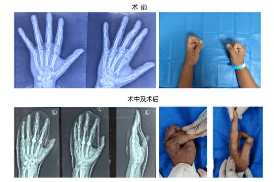 <em>潍坊</em>市<em>人民医院</em>将3D打印假体向肢体远端延伸，成功实施手部关节置换