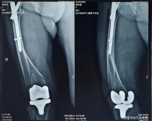 <em>菏泽黄河骨科医院</em>成功完成一例膝关节置换术后假体周围骨折手术