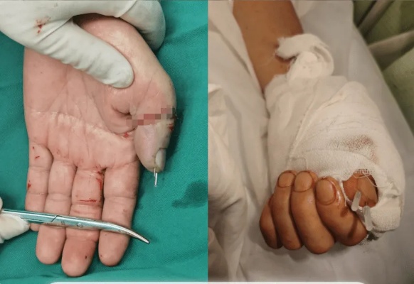 怀化58岁工人手指卷入机器，左手拇指被割断，<em>骨科</em>医生让断指“死而复生”