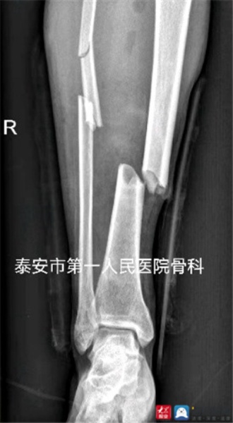 肢体保卫战！泰安市第一人民<em>医院骨科</em>团队为复杂右下肢外伤患者保肢成功