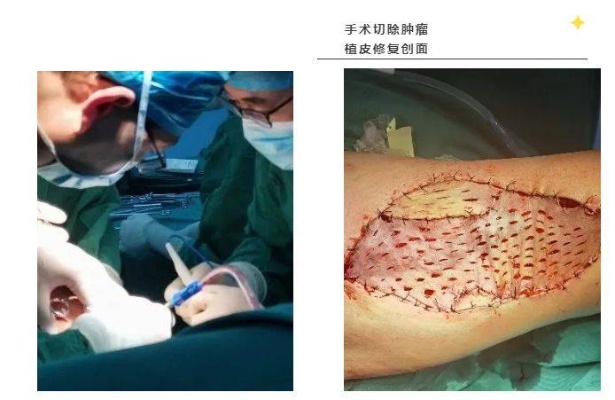 青岛滨海学院附属<em>医院骨科</em>：成功为79岁老人切除腿部巨大恶性肿瘤