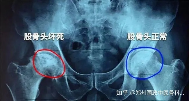 <em>郑州国政中医骨科</em>：这几个要点影响着股骨头坏死恶化快慢！
