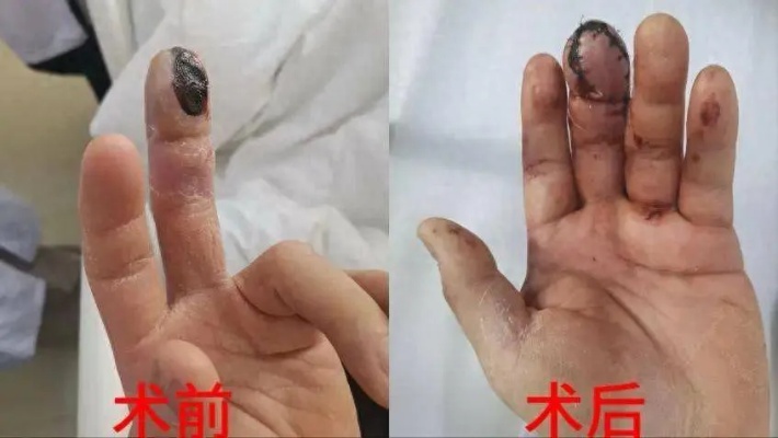 可能导致截指！<em>长沙</em>一男子吃完小龙虾，手指皮肤软组织坏死…