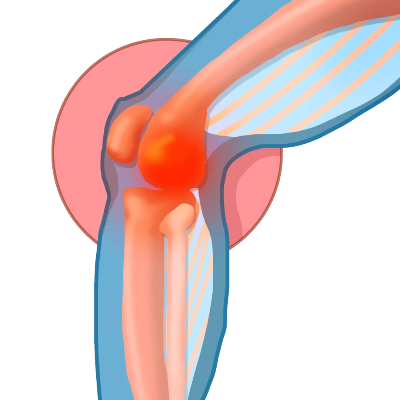 护理科普活动周丨女性的膝<em>关节</em>更易损伤？和这些因素“膝膝”相关！