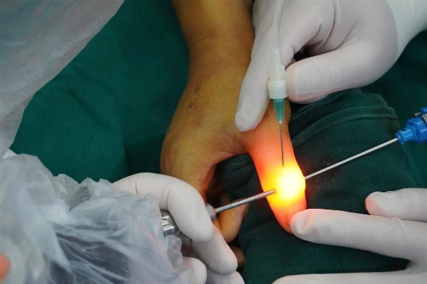 针灸推拿师拇指长骨刺，毫米级微创手术解除疼痛_关节_操作_<em>医生</em>